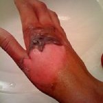 2nd degree burn to the hand